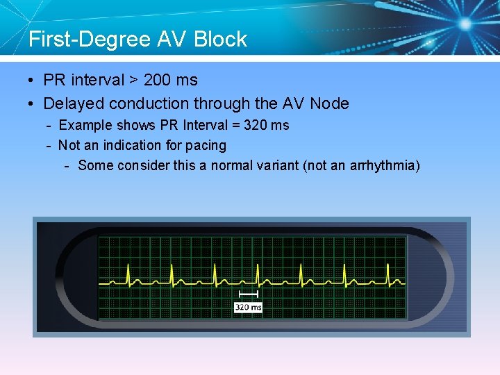 First-Degree AV Block • PR interval > 200 ms • Delayed conduction through the