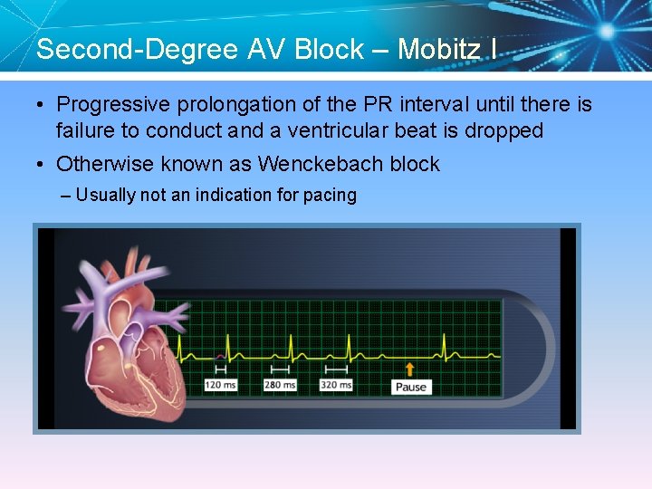 Second-Degree AV Block – Mobitz I • Progressive prolongation of the PR interval until