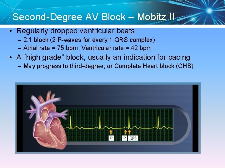 Second-Degree AV Block – Mobitz II • Regularly dropped ventricular beats – 2: 1