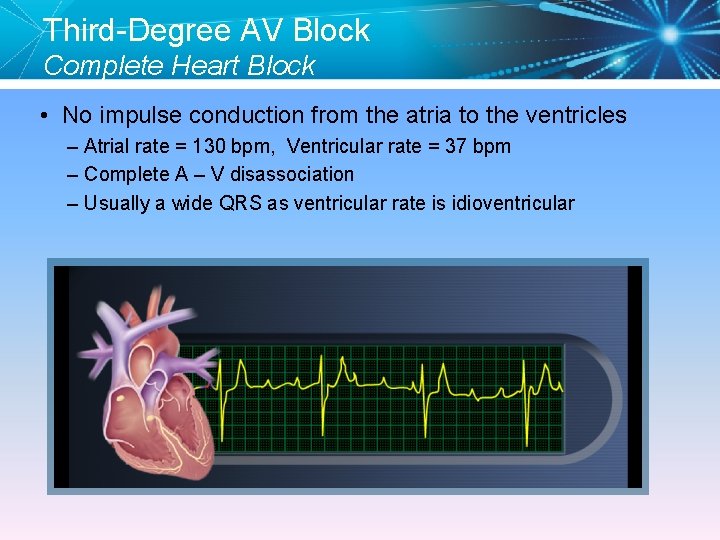 Third-Degree AV Block Complete Heart Block • No impulse conduction from the atria to