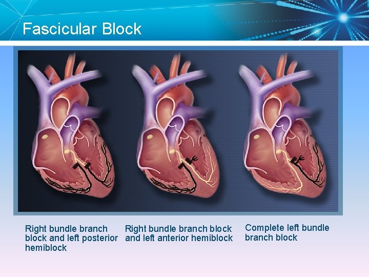 Fascicular Block Right bundle branch block and left posterior and left anterior hemiblock Complete