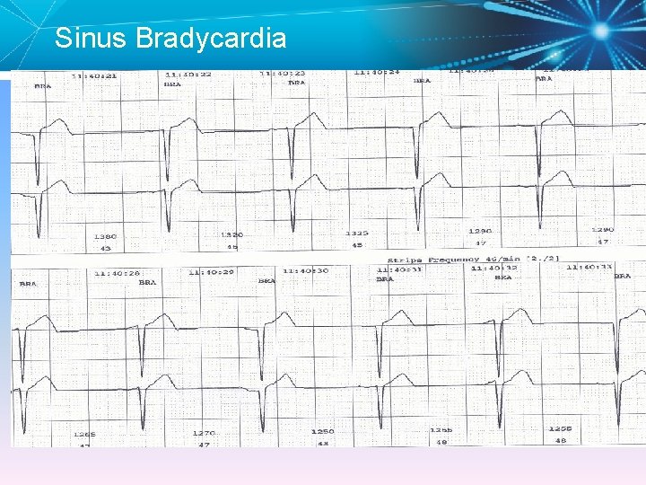 Sinus Bradycardia 