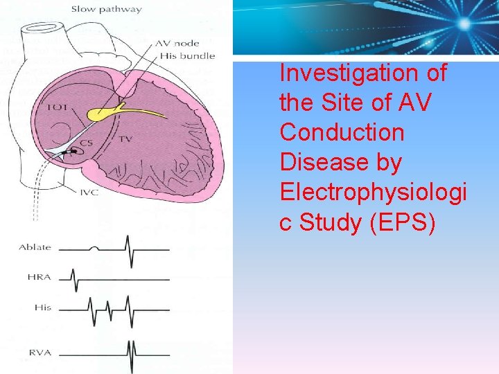 Investigation of the Site of AV Conduction Disease by Electrophysiologi c Study (EPS) 