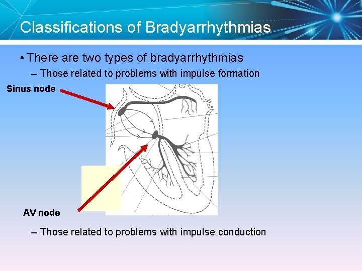 Classifications of Bradyarrhythmias • There are two types of bradyarrhythmias – Those related to