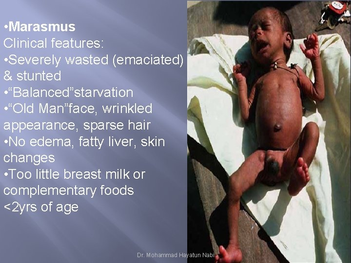  • Marasmus Clinical features: • Severely wasted (emaciated) & stunted • “Balanced”starvation •