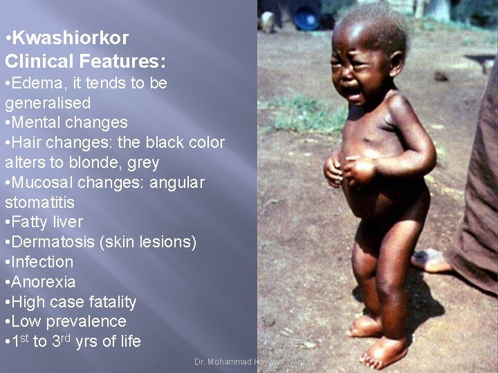  • Kwashiorkor Clinical Features: • Edema, it tends to be generalised • Mental