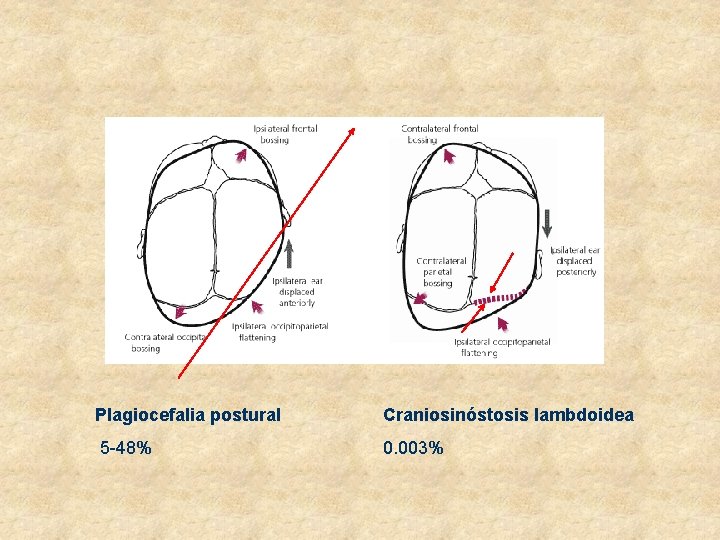 Plagiocefalia postural Craniosinóstosis lambdoidea 5 -48% 0. 003% 