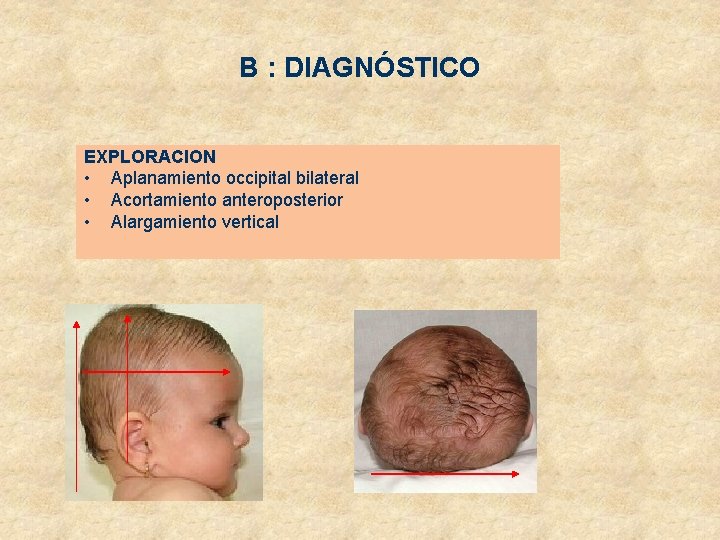 B : DIAGNÓSTICO EXPLORACION • Aplanamiento occipital bilateral • Acortamiento anteroposterior • Alargamiento vertical