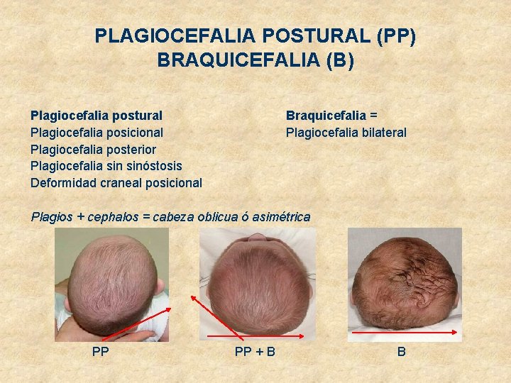 PLAGIOCEFALIA POSTURAL (PP) BRAQUICEFALIA (B) Plagiocefalia postural Plagiocefalia posicional Plagiocefalia posterior Plagiocefalia sinóstosis Deformidad