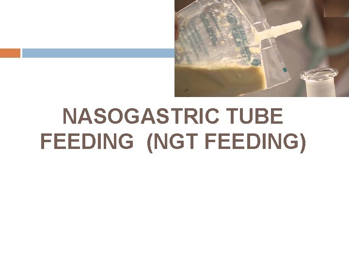 NASOGASTRIC TUBE FEEDING (NGT FEEDING) 