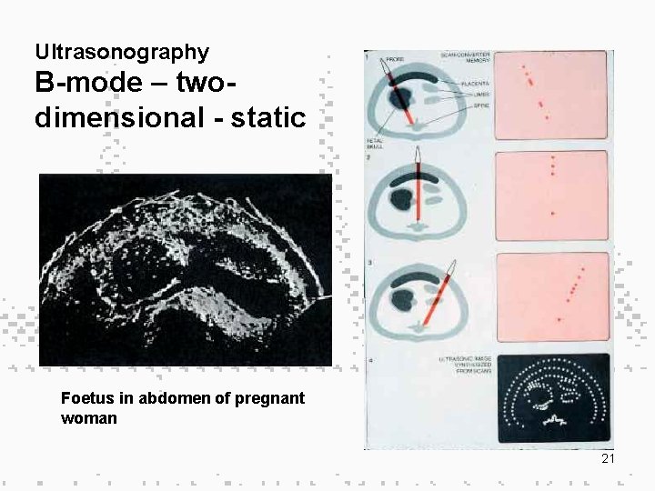 Ultrasonography B-mode – twodimensional - static Foetus in abdomen of pregnant woman 21 