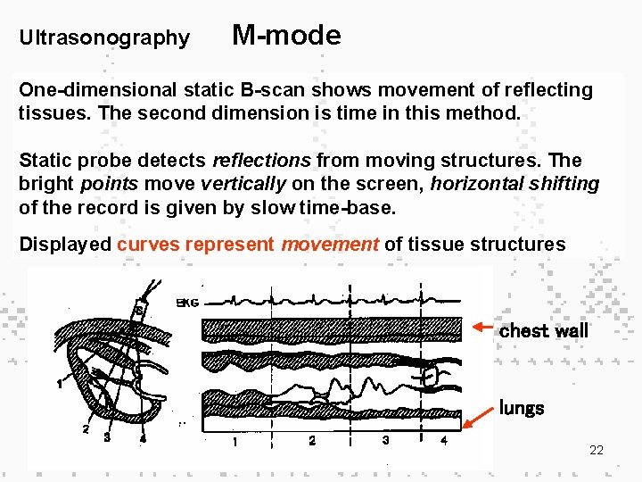 Ultrasonography M-mode One-dimensional static B-scan shows movement of reflecting tissues. The second dimension is