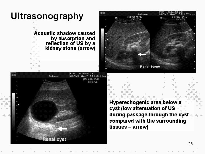 Ultrasonography Acoustic shadow caused by absorption and reflection of US by a kidney stone