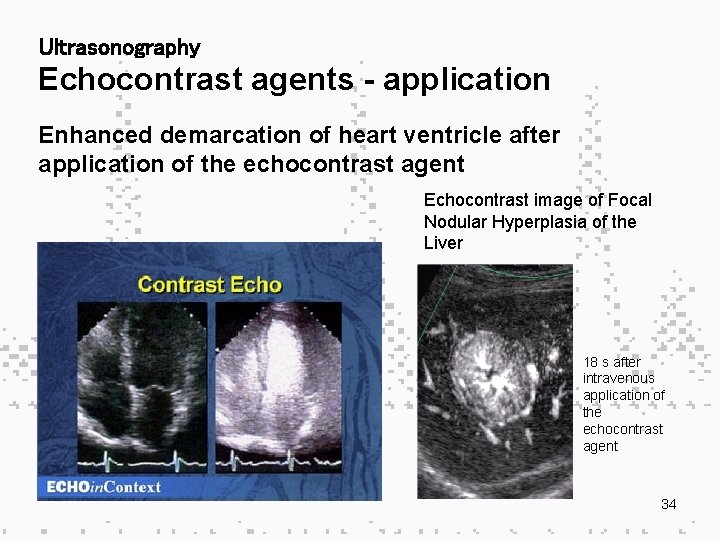 Ultrasonography Echocontrast agents - application Enhanced demarcation of heart ventricle after application of the