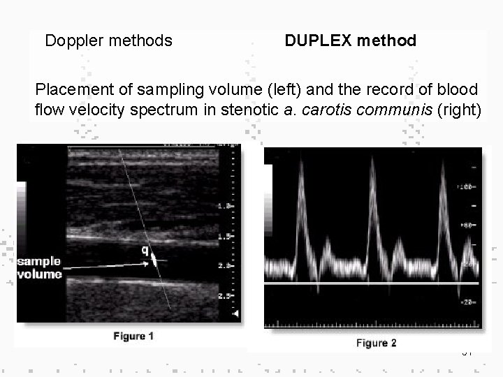 Doppler methods DUPLEX method Placement of sampling volume (left) and the record of blood