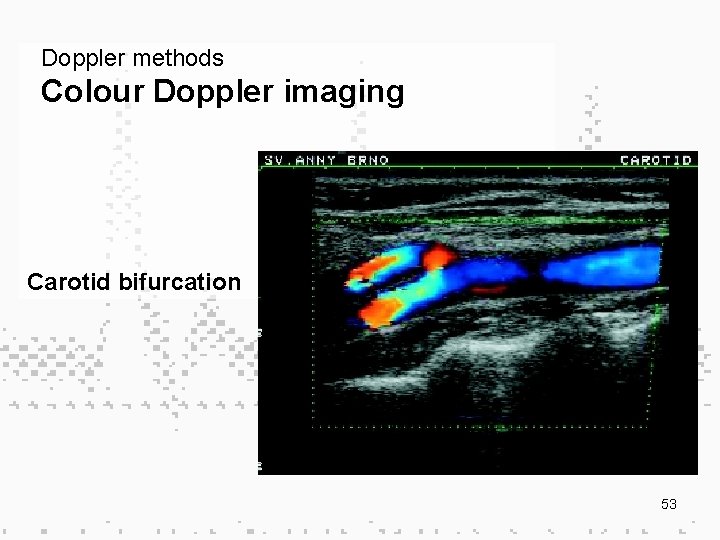Doppler methods Colour Doppler imaging Carotid bifurcation 53 