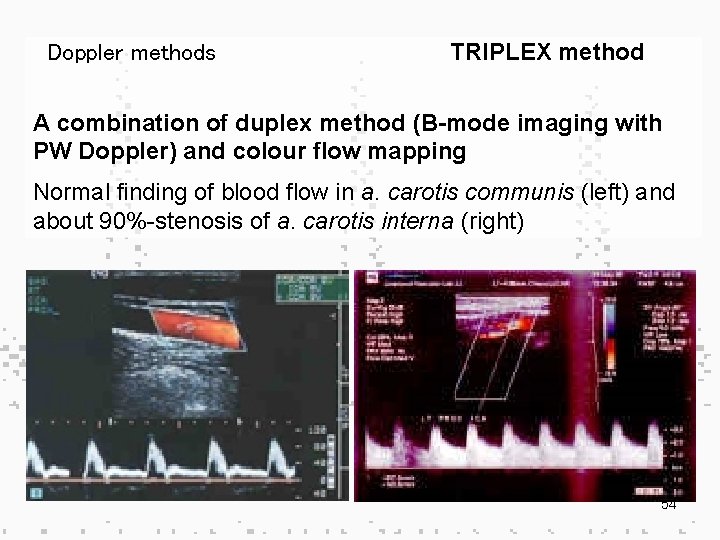 Doppler methods TRIPLEX method A combination of duplex method (B-mode imaging with PW Doppler)