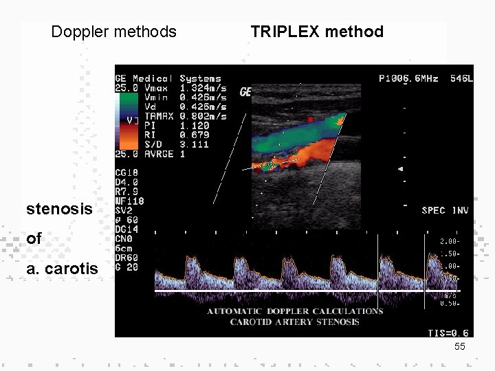 Doppler methods TRIPLEX method stenosis of a. carotis 55 