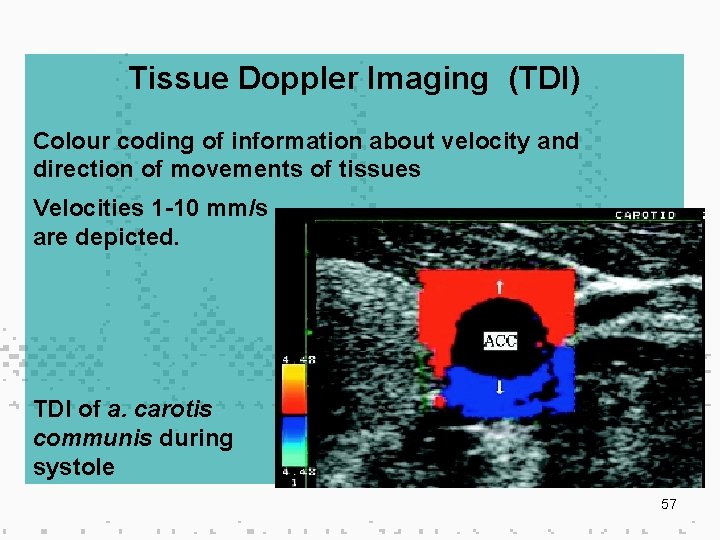 Tissue Doppler Imaging (TDI) Colour coding of information about velocity and direction of movements