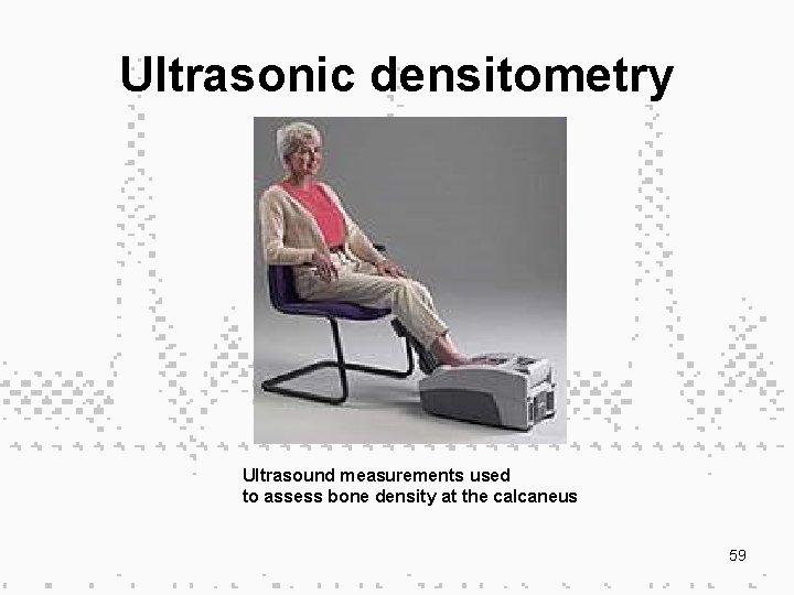 Ultrasonic densitometry Ultrasound measurements used to assess bone density at the calcaneus 59 