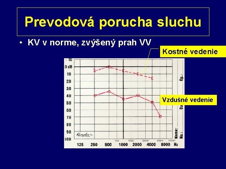 Prevodová porucha sluchu • KV v norme, zvýšený prah VV Kostné vedenie Vzdušné vedenie