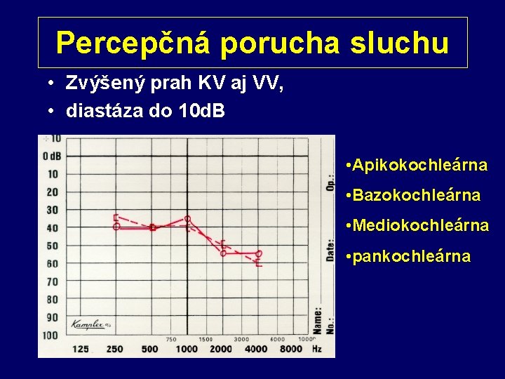 Percepčná porucha sluchu • Zvýšený prah KV aj VV, • diastáza do 10 d.