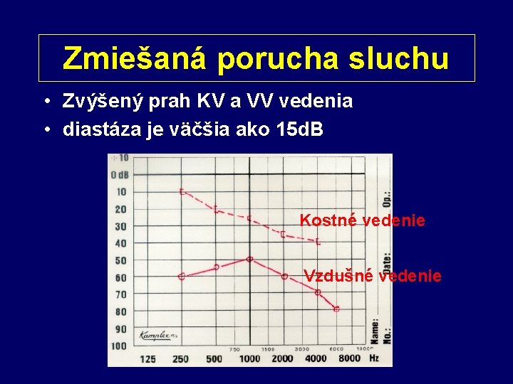 Zmiešaná porucha sluchu • Zvýšený prah KV a VV vedenia • diastáza je väčšia