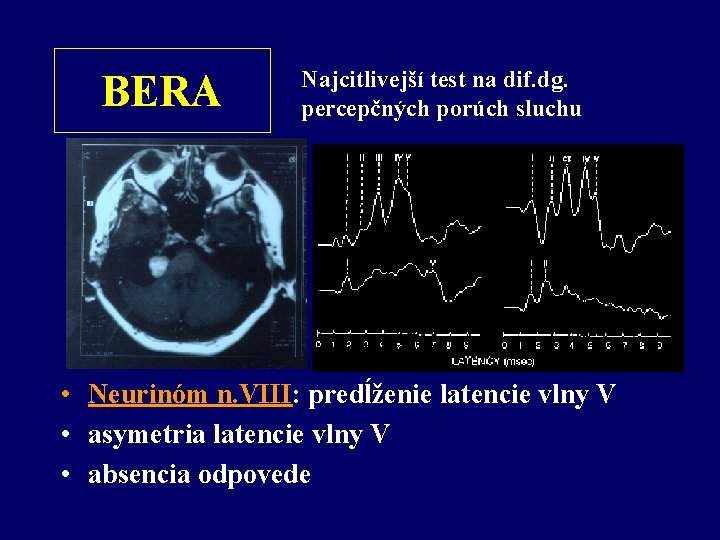 BERA Najcitlivejší test na dif. dg. percepčných porúch sluchu • Neurinóm n. VIII: predĺženie
