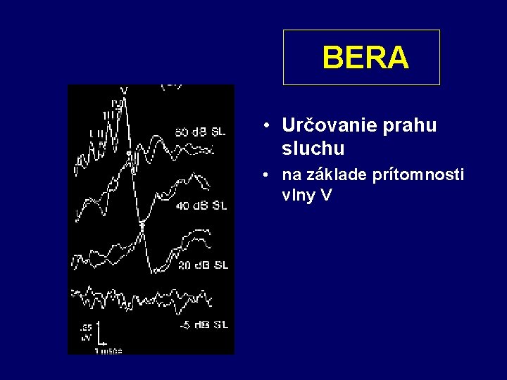 BERA • Určovanie prahu sluchu • na základe prítomnosti vlny V 