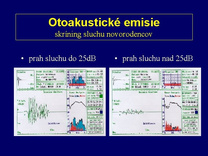 Otoakustické emisie skríning sluchu novorodencov • prah sluchu do 25 d. B • prah