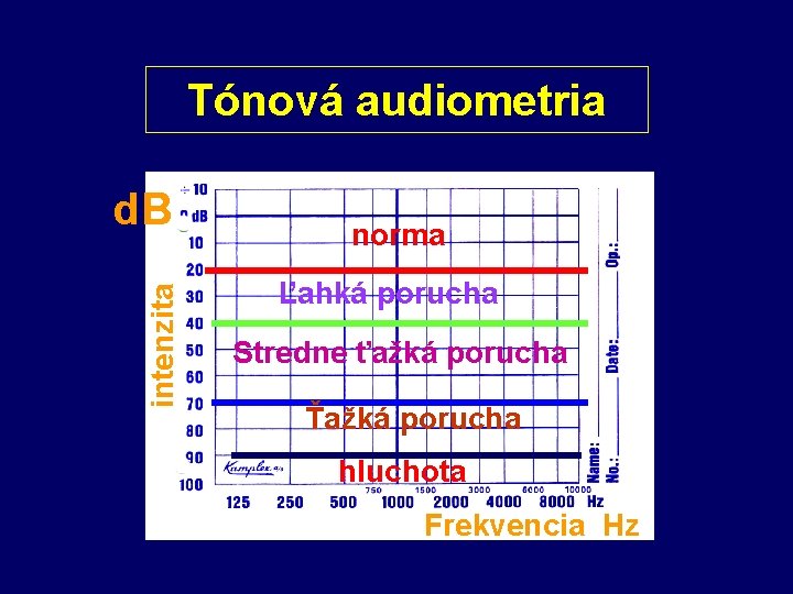 Tónová audiometria intenzita d. B norma Ľahká porucha Stredne ťažká porucha Ťažká porucha hluchota