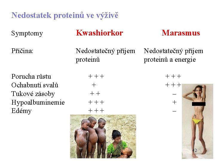 Nedostatek proteinů ve výživě Symptomy Kwashiorkor Marasmus Příčina: Nedostatečný příjem proteinů a energie Porucha