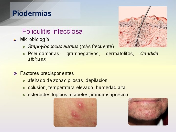 Piodermias Foliculitis infecciosa Microbiología v Staphylococcus aureus (más frecuente) v Pseudomonas, gramnegativos, dermatofitos, albicans