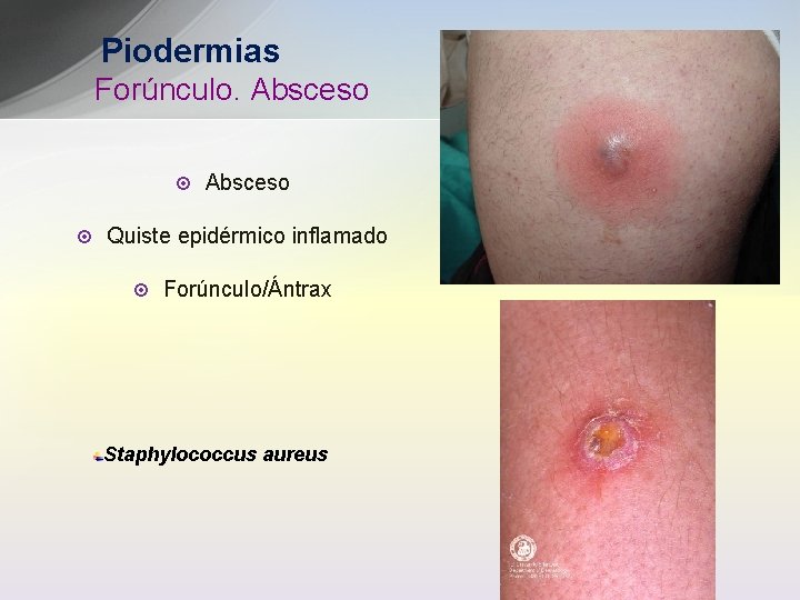 Piodermias Forúnculo. Absceso ¤ ¤ Absceso Quiste epidérmico inflamado ¤ Forúnculo/Ántrax Staphylococcus aureus 