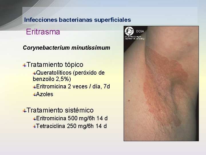 Infecciones bacterianas superficiales Eritrasma Corynebacterium minutissimum Tratamiento tópico Queratolíticos (peróxido de benzoilo 2, 5%)
