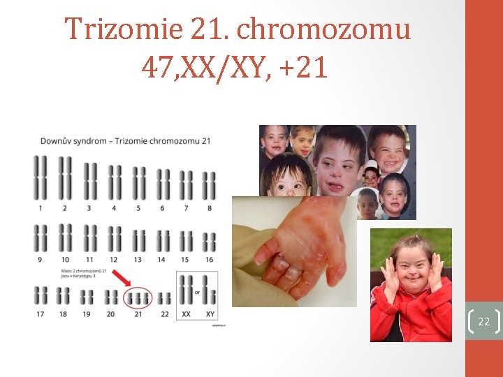 Trizomie 21. chromozomu 47, XX/XY, +21 22 