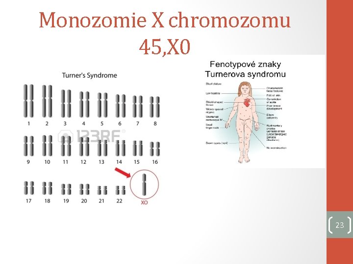 Monozomie X chromozomu 45, X 0 23 