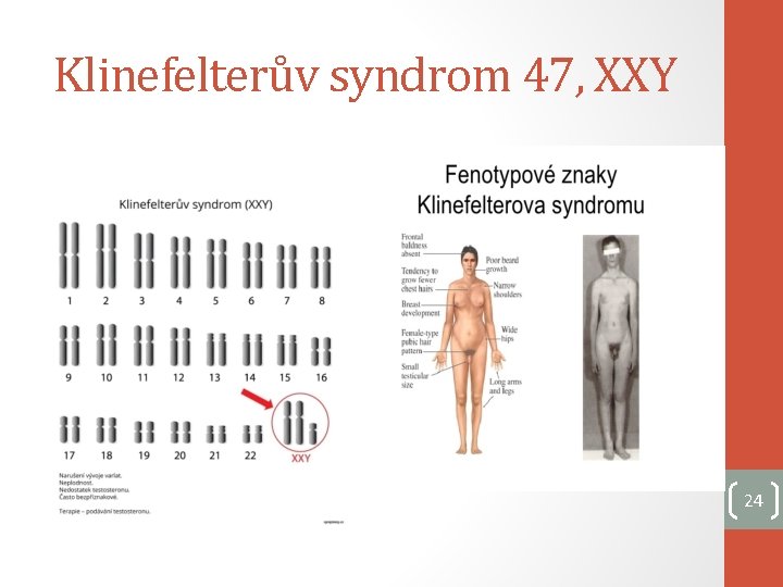 Klinefelterův syndrom 47, XXY 24 