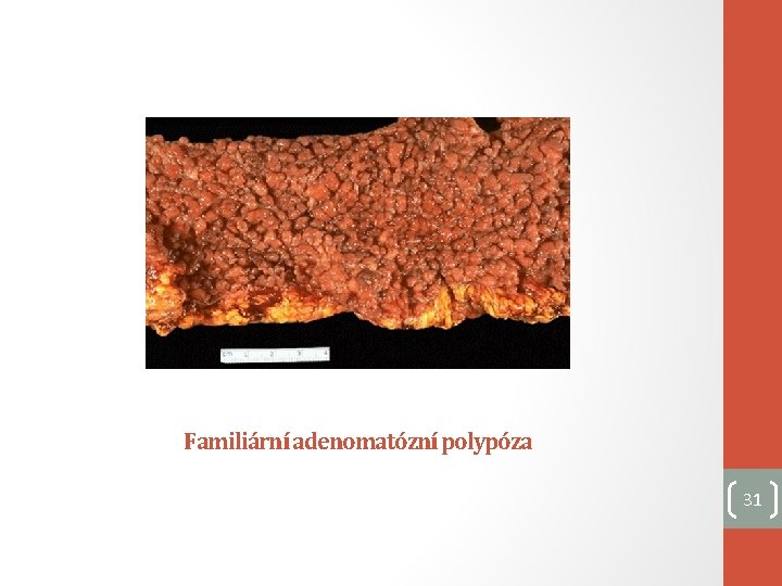 Familiární adenomatózní polypóza 31 