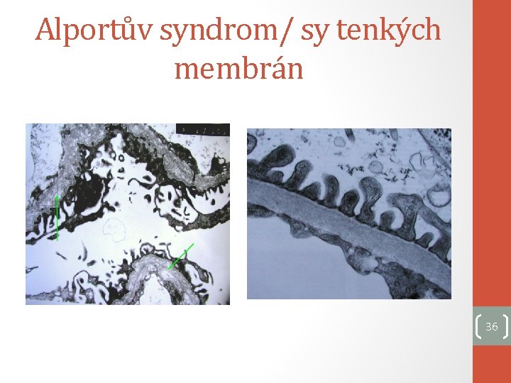 Alportův syndrom/ sy tenkých membrán 36 