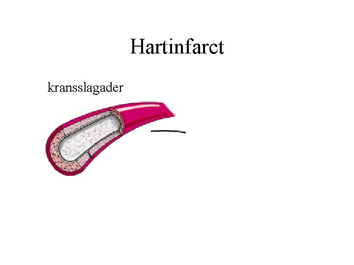 Hartinfarct kransslagader 