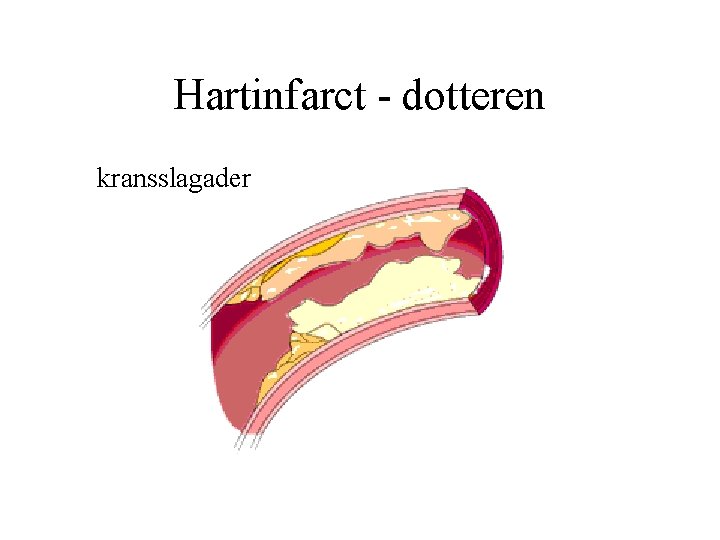 Hartinfarct - dotteren kransslagader 