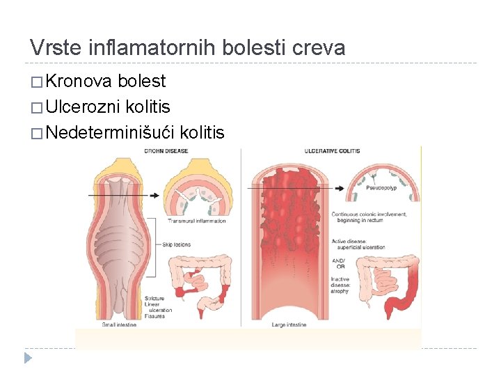 Vrste inflamatornih bolesti creva � Kronova bolest � Ulcerozni kolitis � Nedeterminišući kolitis 