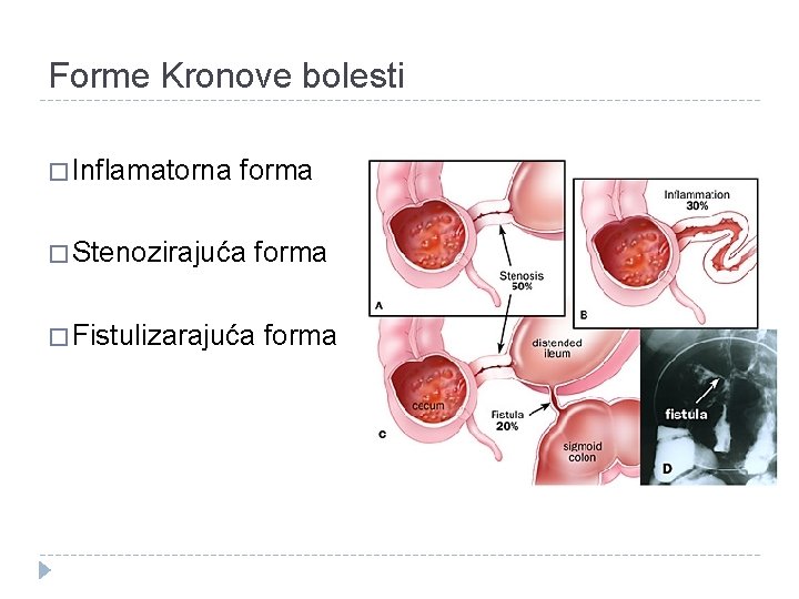 Forme Kronove bolesti � Inflamatorna forma � Stenozirajuća forma � Fistulizarajuća forma 