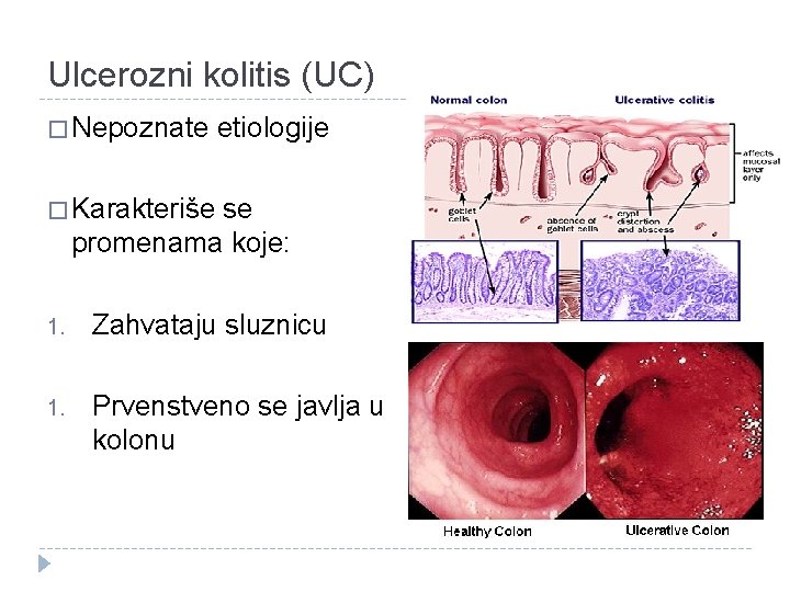 Ulcerozni kolitis (UC) � Nepoznate etiologije � Karakteriše se promenama koje: 1. Zahvataju sluznicu Ulcerozni kolitis (UC) � Nepoznate etiologije � Karakteriše se promenama koje: 1. Zahvataju sluznicu