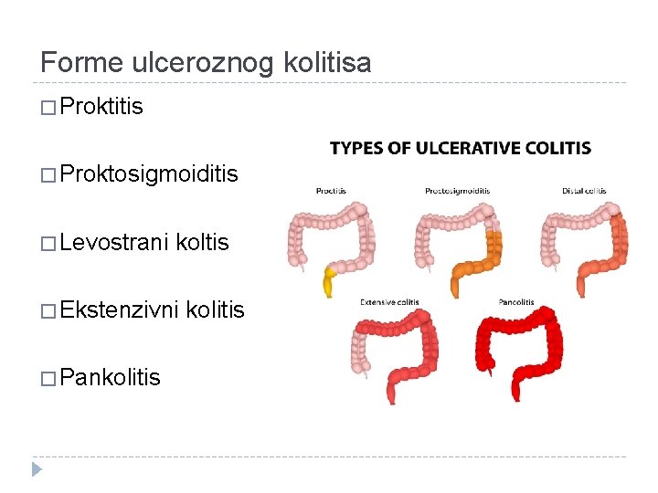 Forme ulceroznog kolitisa � Proktitis � Proktosigmoiditis � Levostrani koltis � Ekstenzivni kolitis �