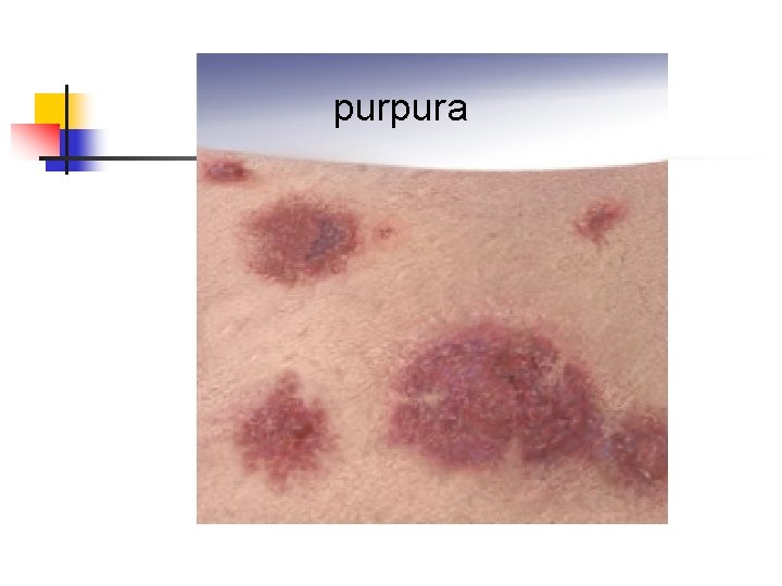 purpura 