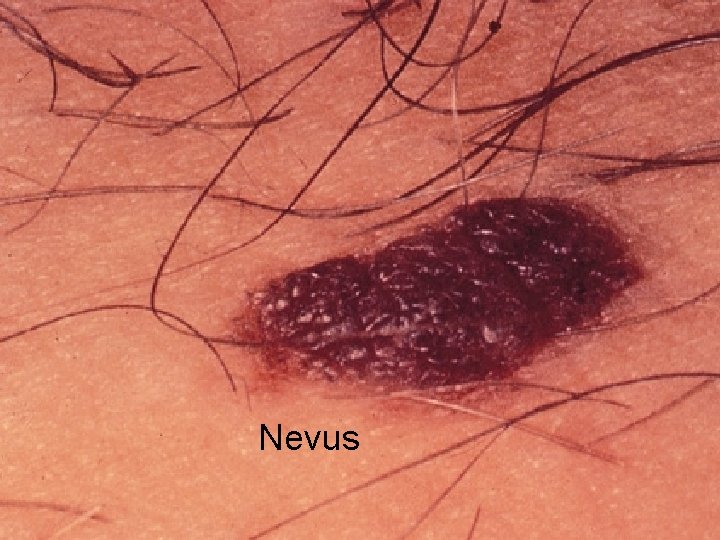 Nevus 