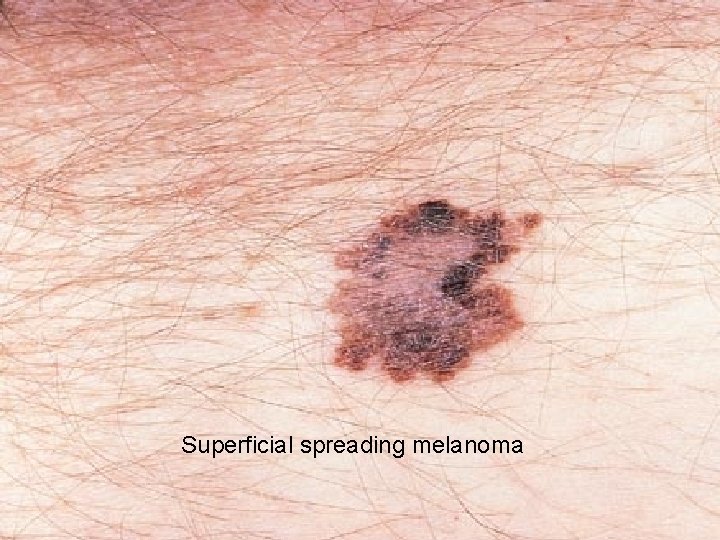 Superficial spreading melanoma 
