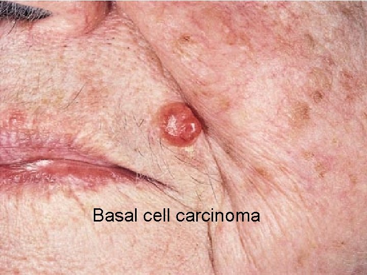 Basal cell carcinoma 